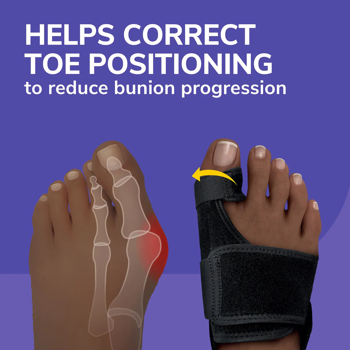 Bunion Relief and Toe Corrector
